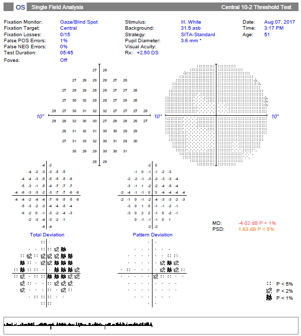 Study shows 10-2 VF testing doesn’t detect any additional defect not already seen on 24-2 testing, but it provides sufficient additional information for patients with a repeatable defect within the central 12 locations of the 24-2 VF test.