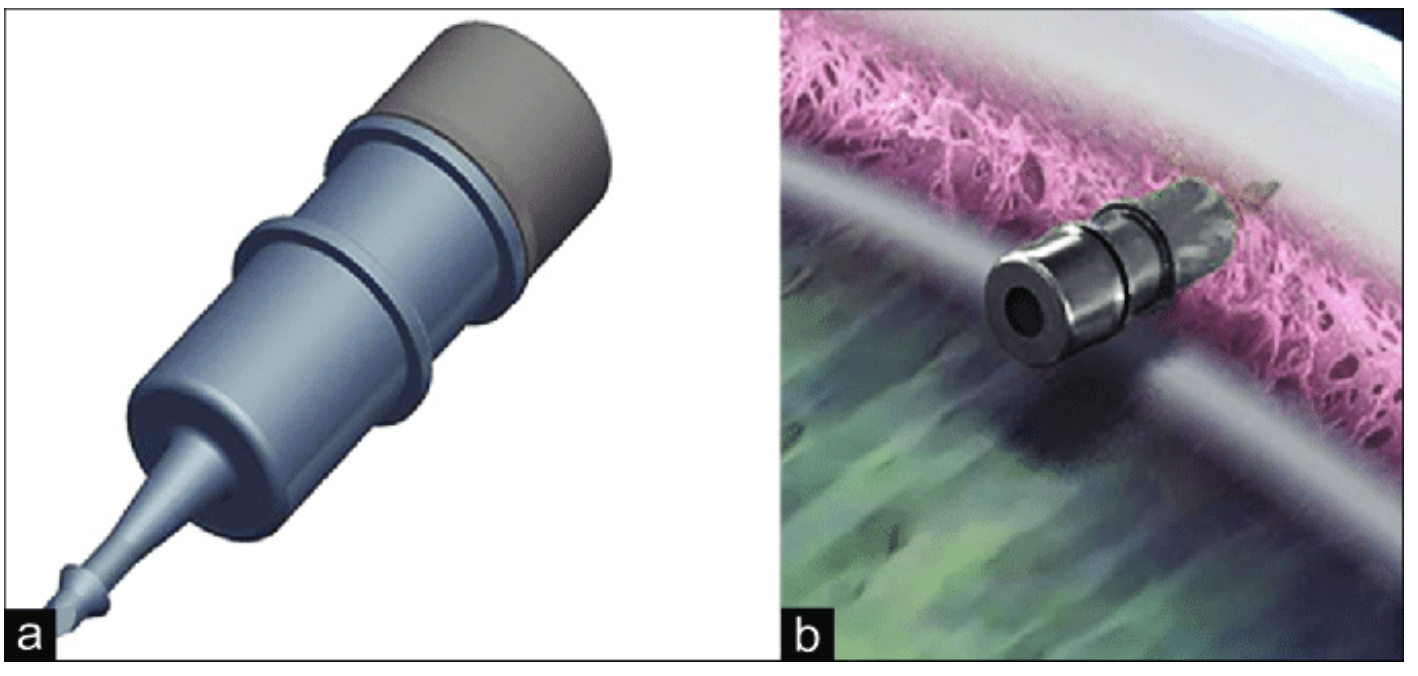 iDose TR intracameral implant. (a) The iDose TR magnified. (b) Device anchored to the sclera.