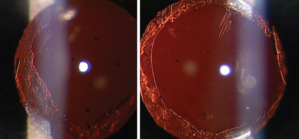 Fig. 1. IOL pits caused by YAG capsulotomy.