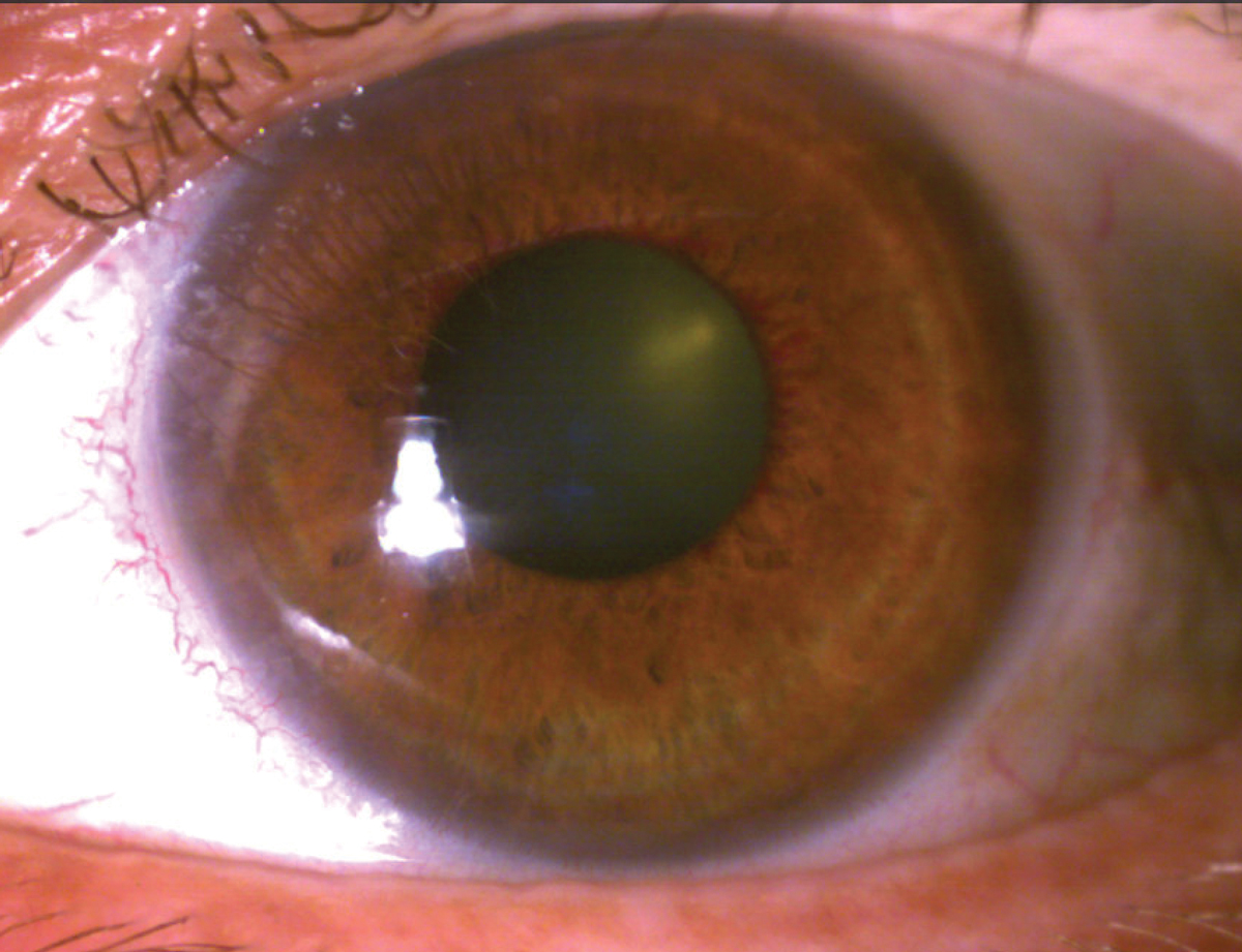 Ischemic Retinal Ordeal