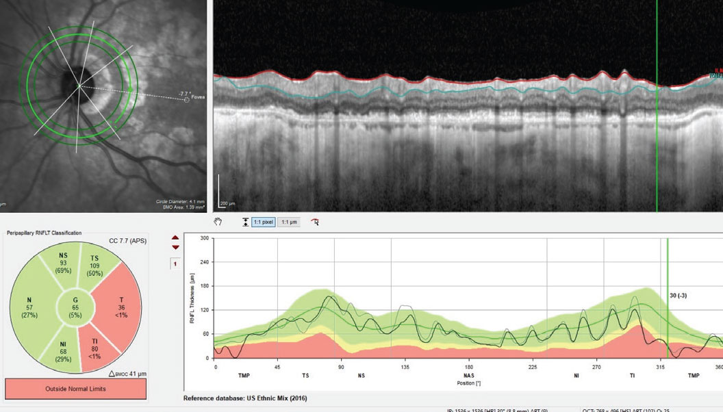 Fig. 4. The RNFL circle scan of the left eye. Note that GA particularly can sometimes interfere with thickness readings of the RNFL if the circle scan encompasses areas affected by GA.