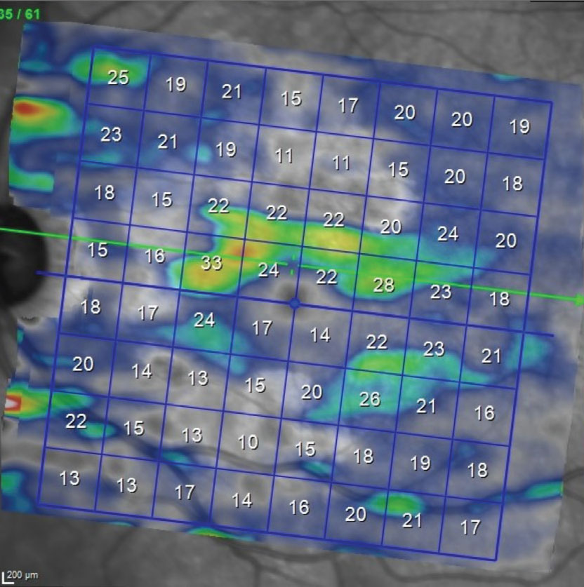 Fig. 3. OS macular ganglion cell layer thickness map. Note the paucity of the ganglion cell thickness below the horizontal raphe. This reduction in ganglion cells correlates well with the superior arcuate scotoma seen on the visual field.  Note in Figure 1 the asymmetry between the superior and inferior hemispheres related to the GA; of particular importance, the GA is less evident inferiorly than superiorly, enabling us to isolate glaucomatous damage to the ganglion cell layer due to glaucoma rather than AMD.