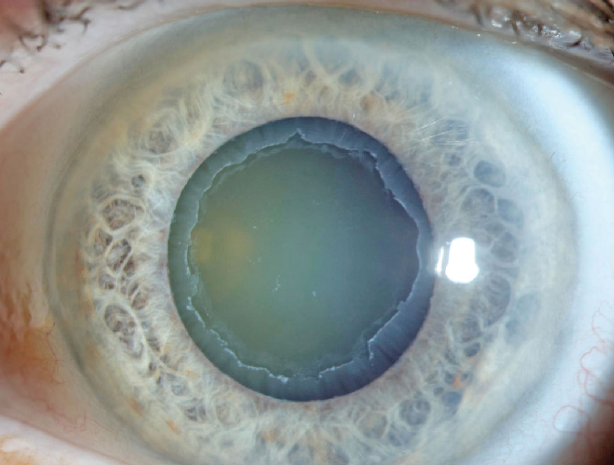 OCT guided progression analysis showed that RNFL thinning progression appeared mainly in the superotemporal and inferotemporal areas in POAG and the temporal area in PXG. In both diseases, progressive GCIPL thinning was most common in the inferotemporal area.