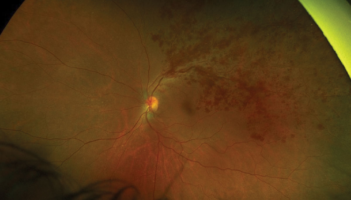 Recent findings implied that both green and red channel hemorrhage measurements can provide some indication of nonperfusion areas, with greater value attributed to peripheral hemorrhages.