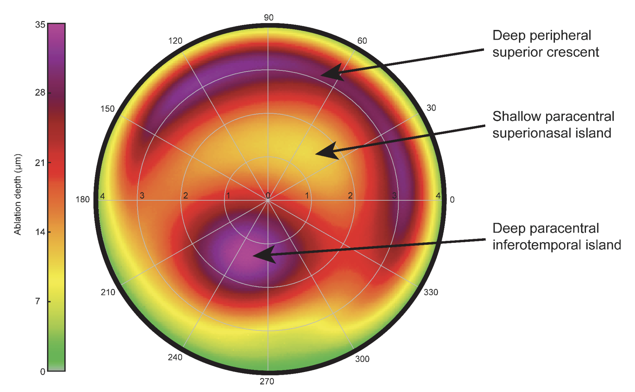 Like keratoconic eyes, postoperative ectasia often manifests with an inferiorly displaced cone, a unique and highly recognizable pattern on an HOA ablation map.