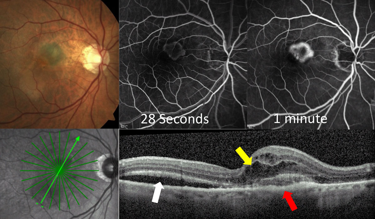 The connection between kidney function and AMD may be attributed to shared risk and genetic factors and pathogenic mechanisms. Notably, only late AMD (and not early AMD) showed an association with compromised kidney function in this study. 