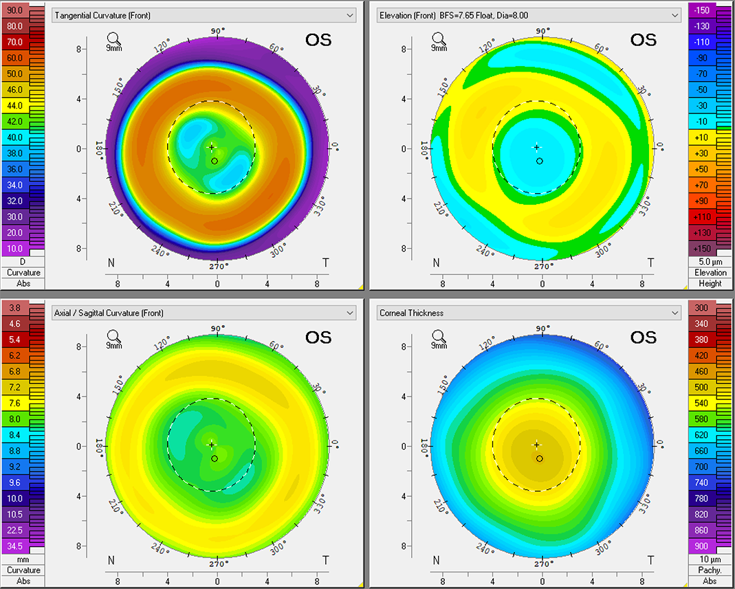 Pentacam Exam Could Improve Ortho-K Efficacy