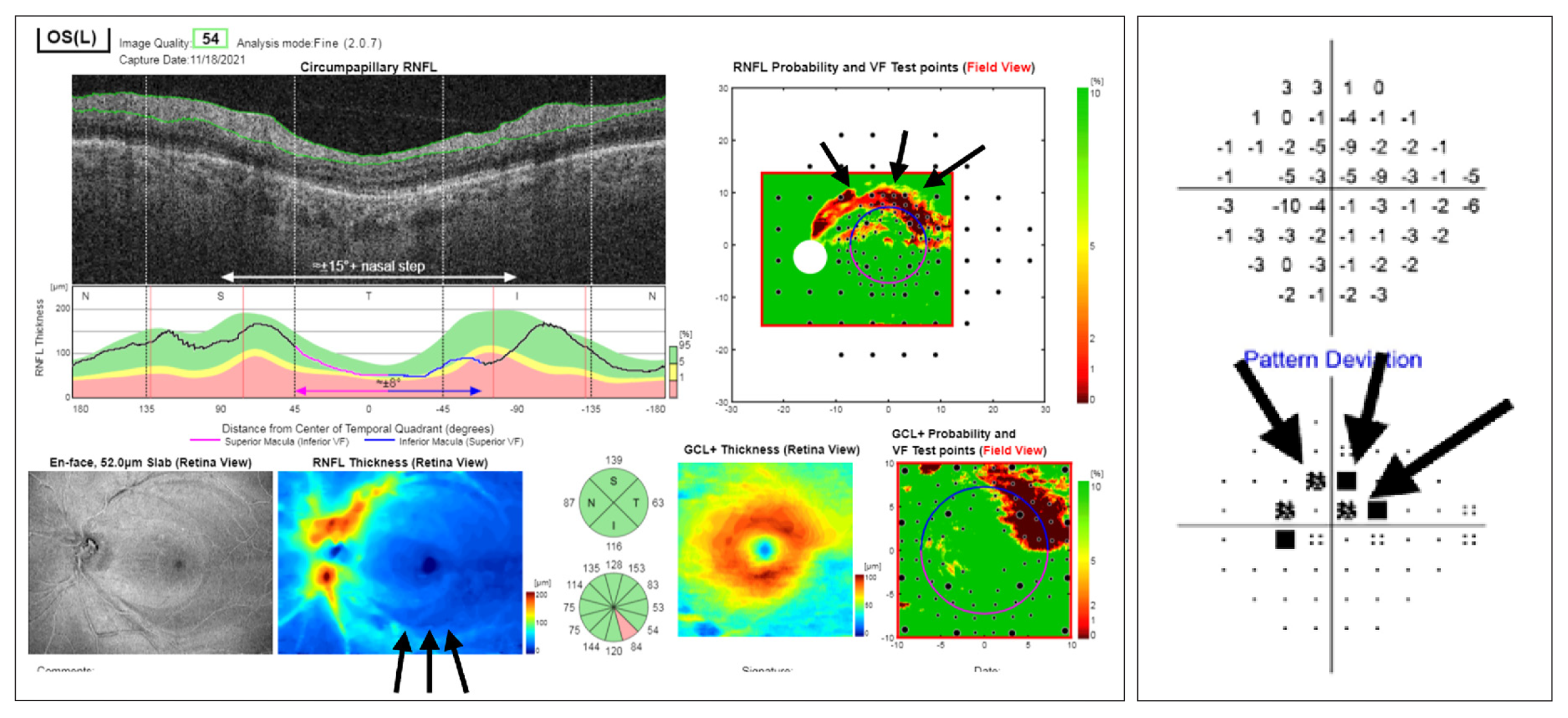 Using a classification based on the fifth percentile, as is used in clinical practice, RNFL was shown to be superior to BMO-MRW in terms of sensitivity in glaucoma diagnosis with large optic discs.