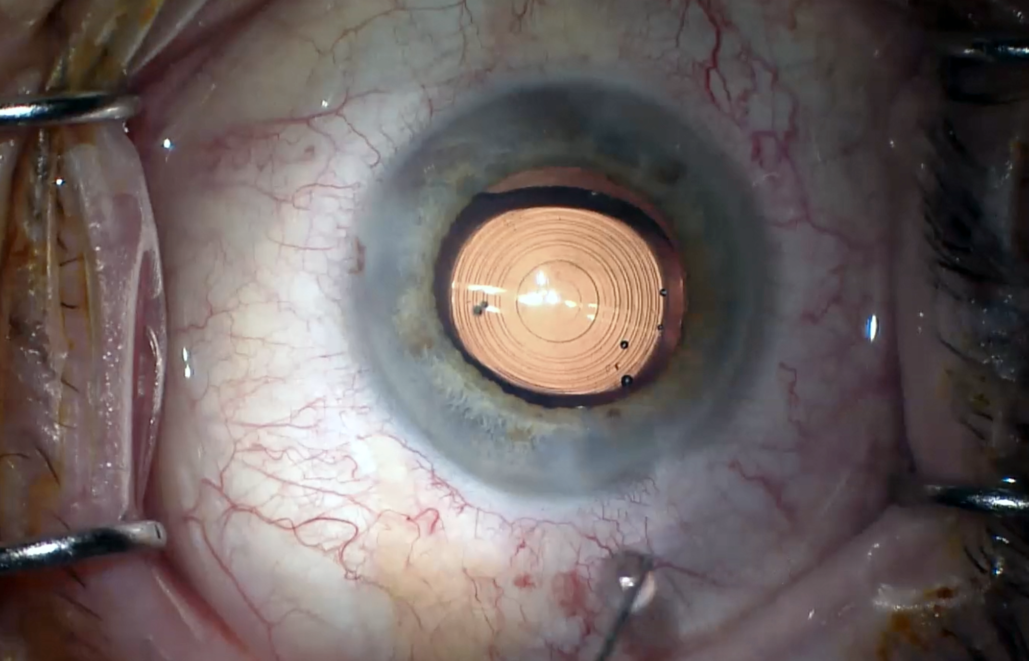 Pseudophakic patients with AMD or ERM showed similar contrast adaptation as healthy controls in this study. 