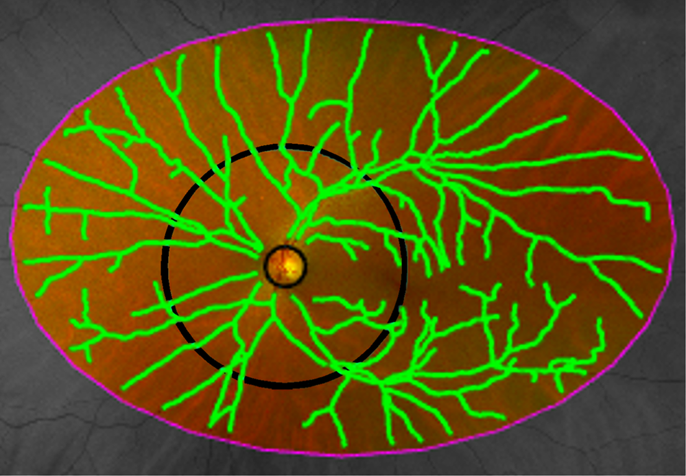 This study used a conventional Optos UWF imaging device to capture images, which were then analyzed by custom software to segment retinal vessels. The researchers manually selected the largest and longest artery and vein pair within each quadrant (superotemporal, inferotemporal, inferonasal, superonasal); vessel widths and tortuosity were extracted from these annotated vessel paths.