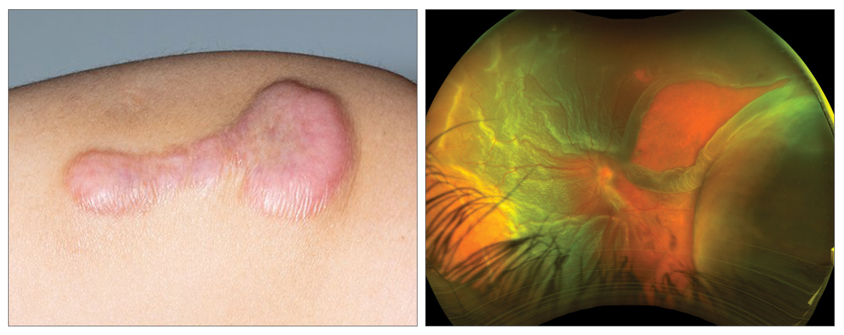 When including all retinal detachment repair types, the rate of PVR diagnosis was still significantly greater in the cohort with keloids, hypertrophic scars and fibrosis within 180 days from surgery.