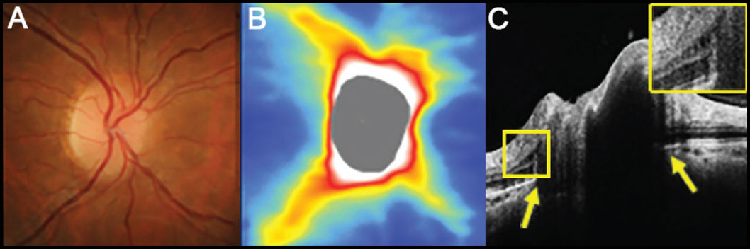 The results of this study uniquely demonstrated that non-IIH papilledema cases have higher rates of disc edema, indicated through high RNFL thickness, when compared with NAION and optic neuritis. In figure (A), the disc has minimal visible cup with some subtle blurring of the superonasal disc margin. Figure (B) shows an OCT thickness heat map demonstrating thick superior and inferior RNFL while (C) presents a high-density OCT line scan shows anterior protrusion of Bruch’s membrane at its opening (yellow arrows) and intraretinal cystic spaces temporal to the disc margin (inset).