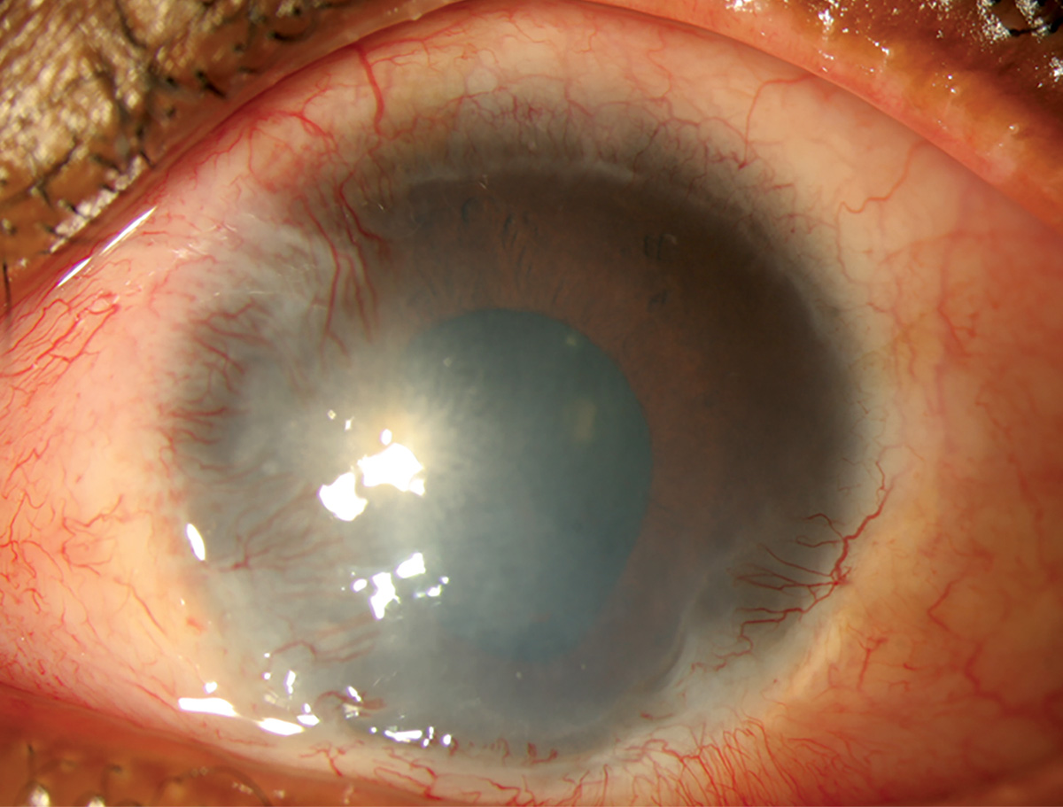 Limbal stem cell deficiency