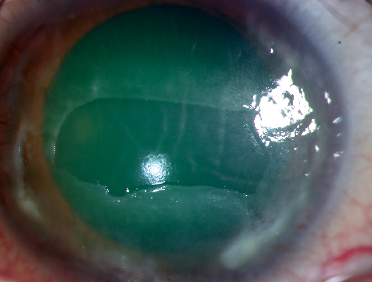 Neurotrophic keratitis