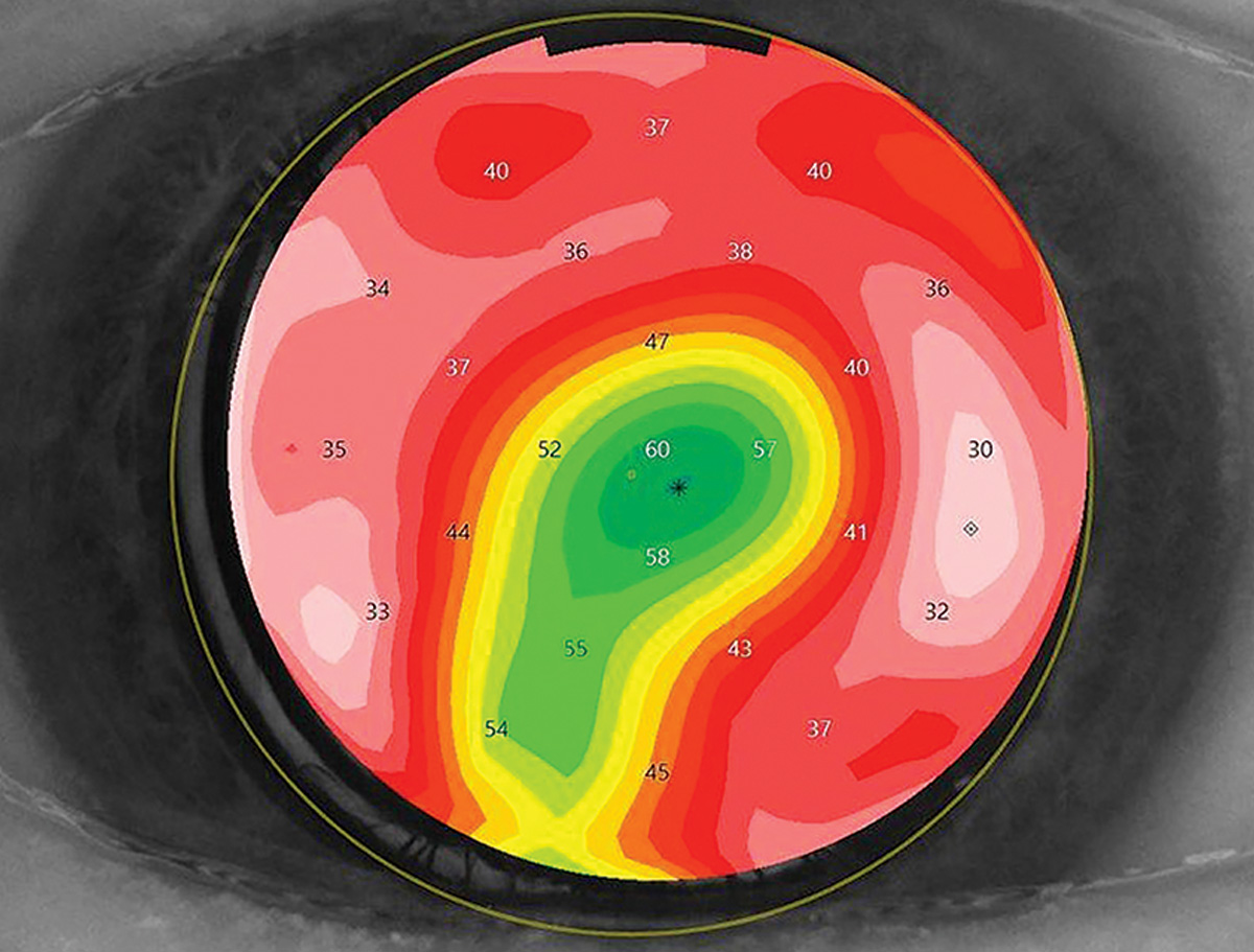 The Many Mishaps of the Anterior Segment