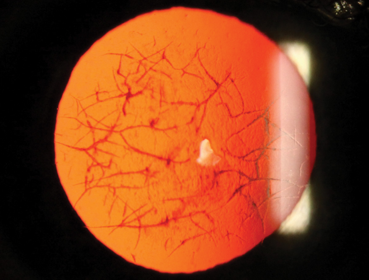 Lattice dystrophy