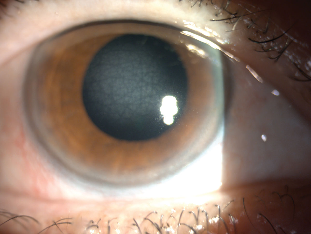 Central corneal dystrophy of François