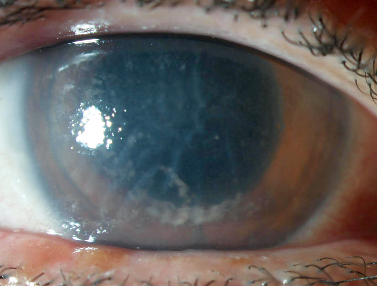 HSV keratouveitis