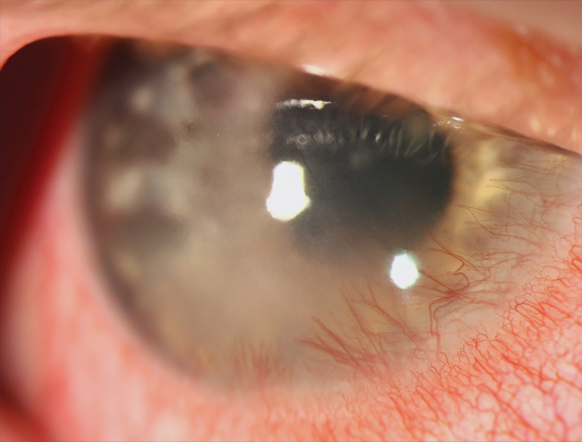 HSV keratitis