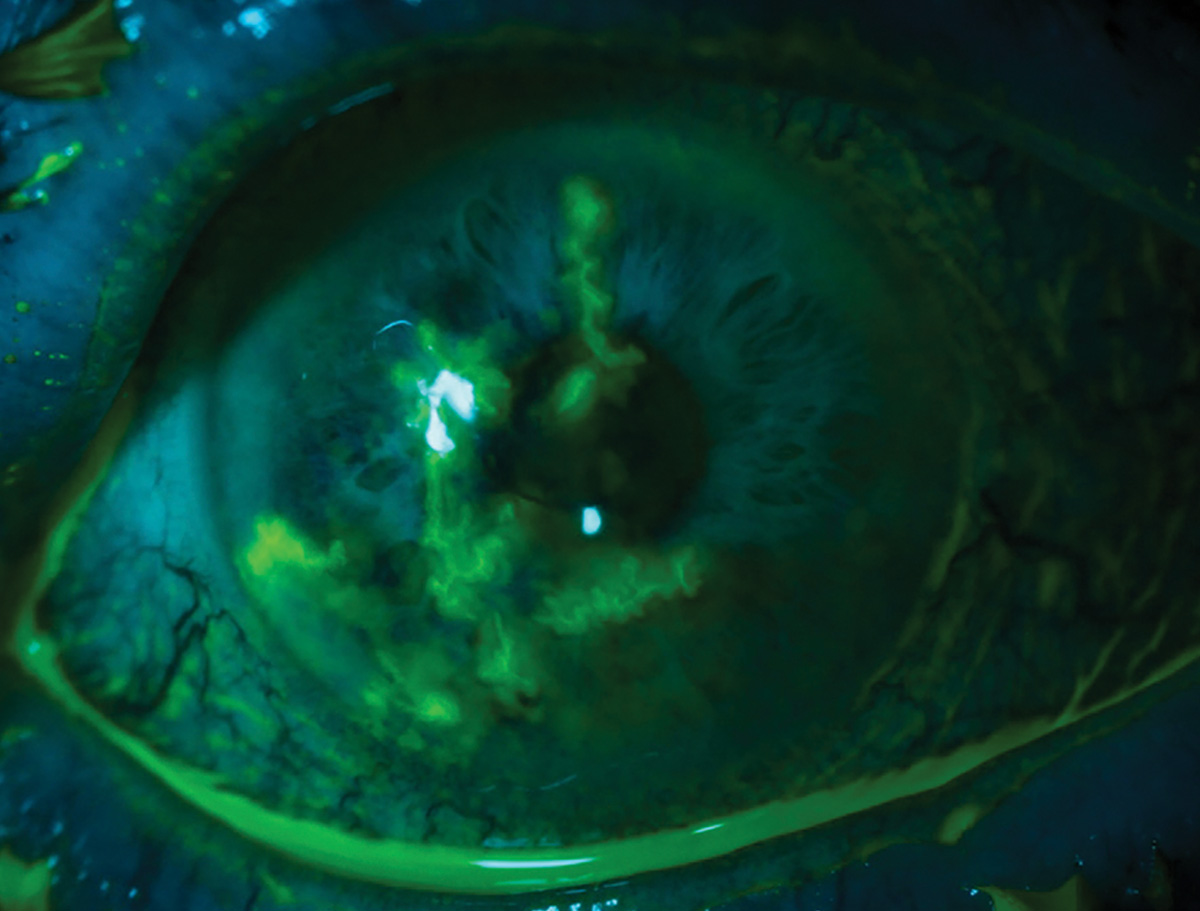 HSV keratitis