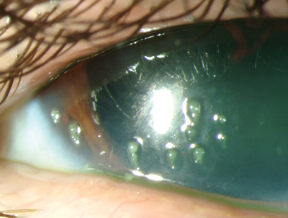 Filamentary keratitis