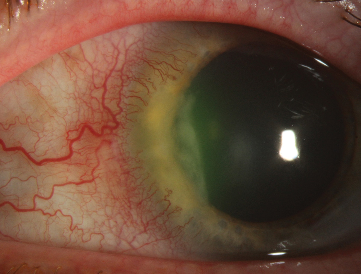 Peripheral ulcerative keratitis