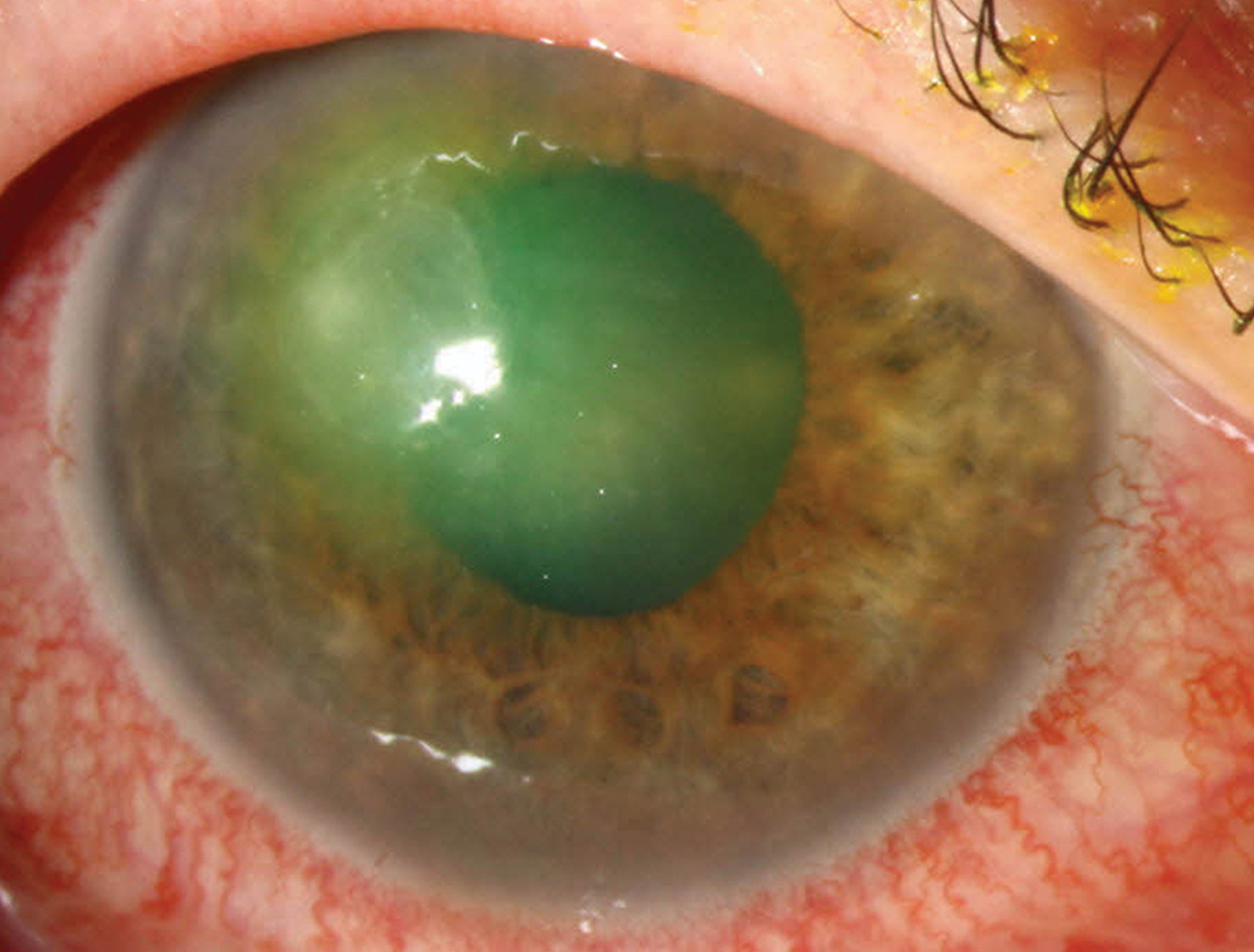 Pseudomonas keratitis