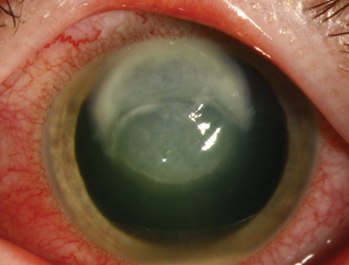 Pseudomonas keratitis