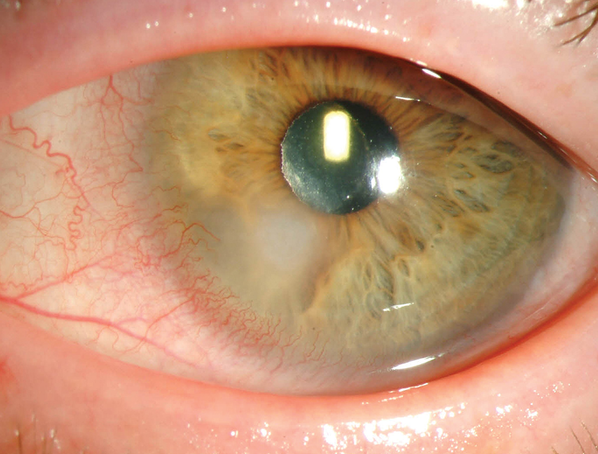 Microbial keratitis