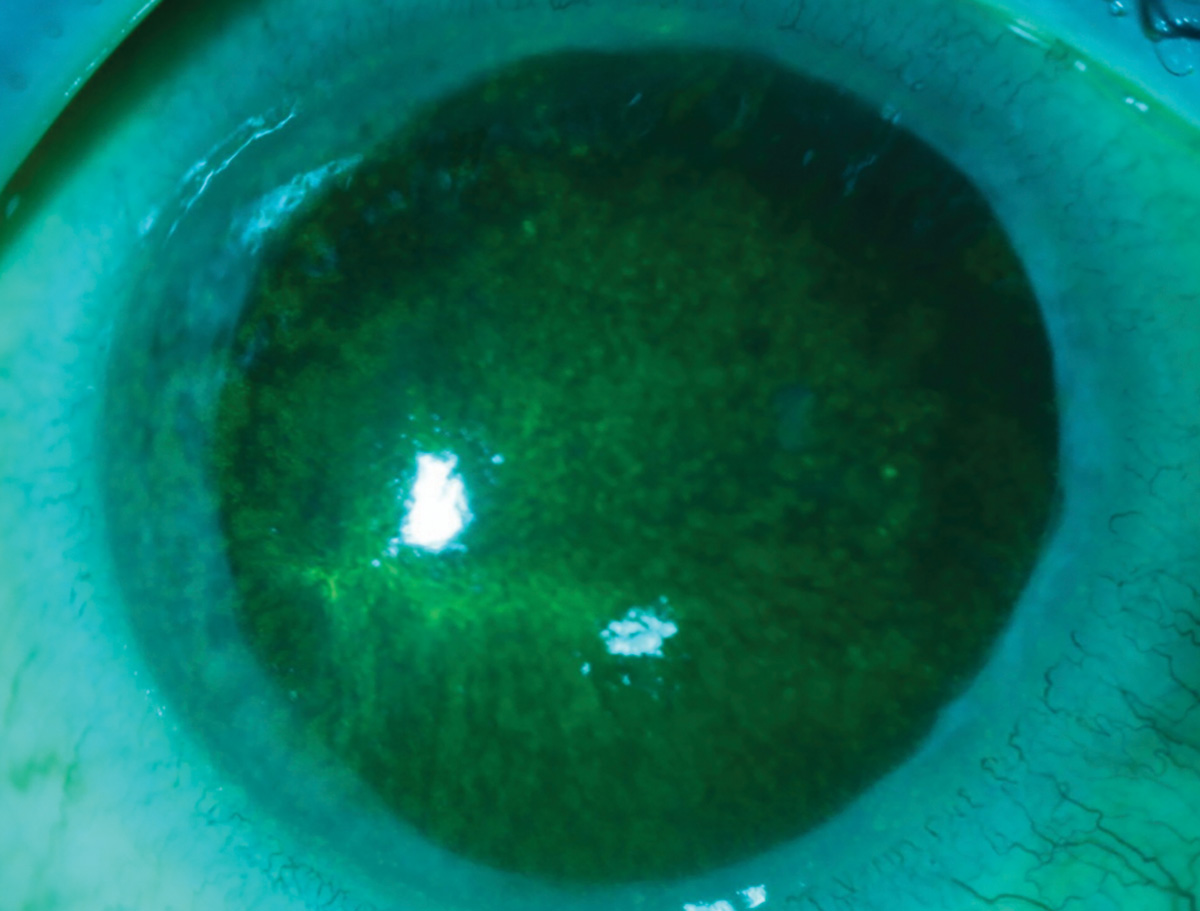 Acanthamoeba keratitis