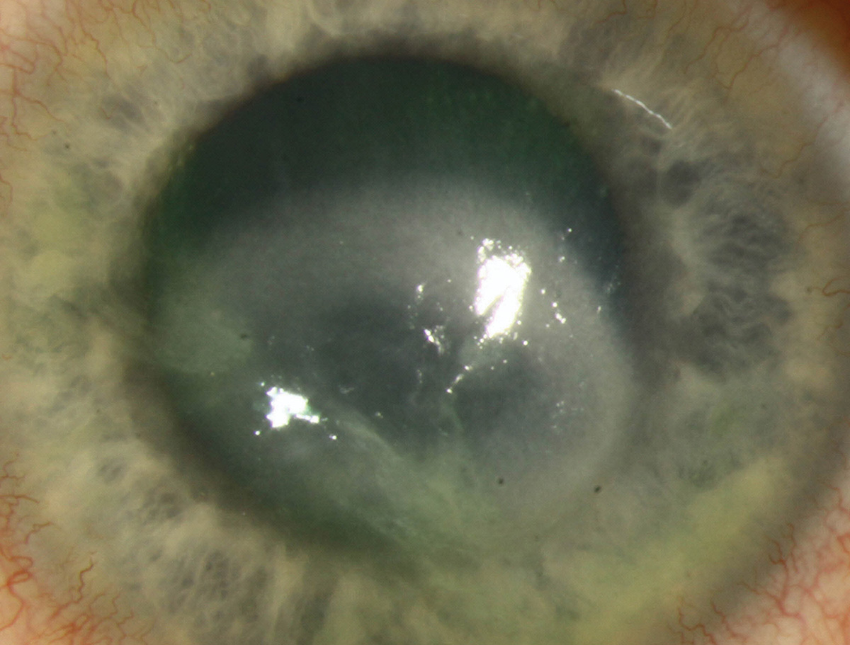 Acanthamoeba keratitis