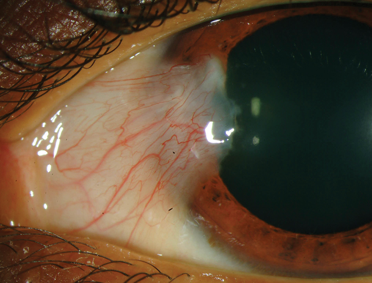 Pterygium