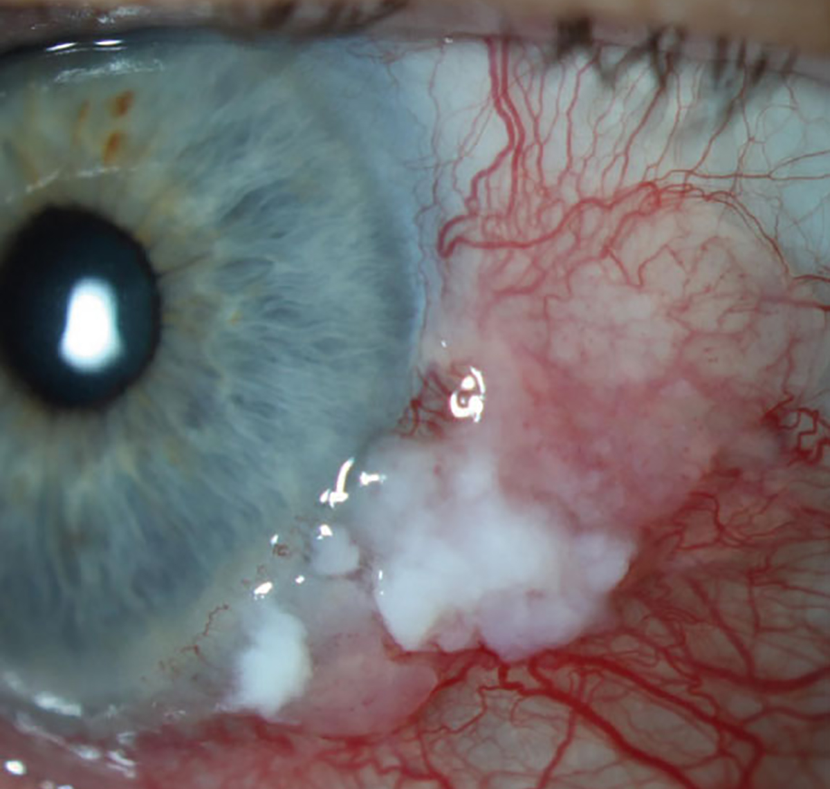 Conjunctival intraepithelial neoplasm