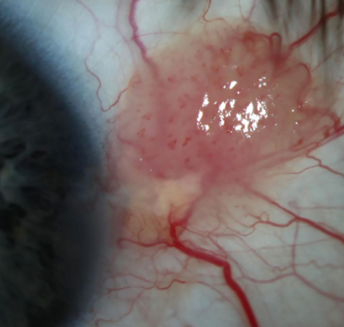 Conjunctival intraepithelial neoplasm