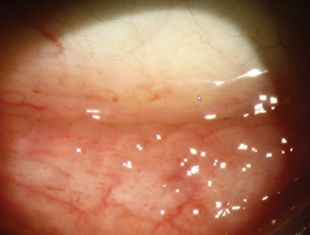 Follicular conjunctivitis