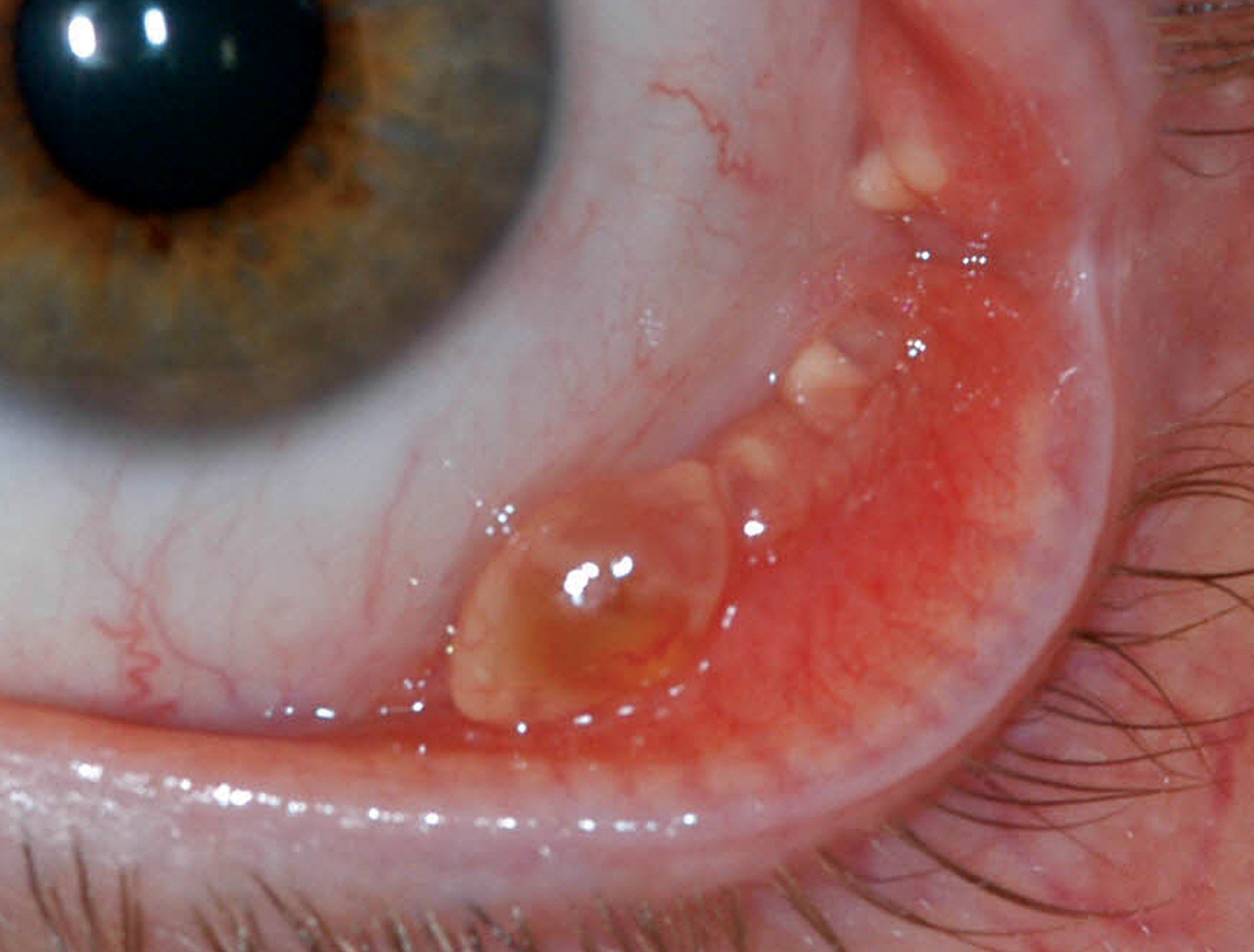 Conjunctival cyst