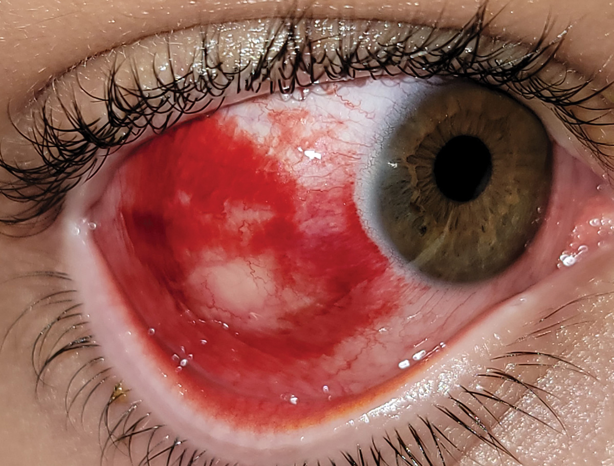 Subconjunctival hemorrhage