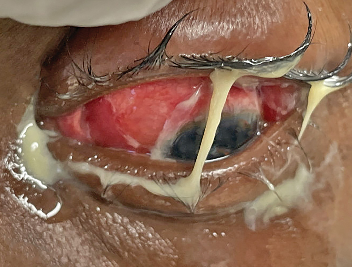 Gonorrhea conjunctivitis