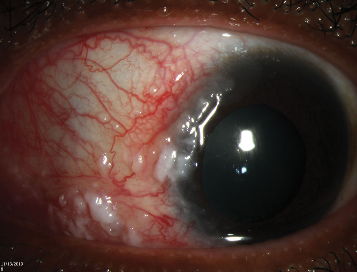 Ocular surface squamous neoplasia