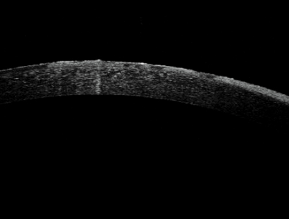 Ocular surface squamous neoplasia