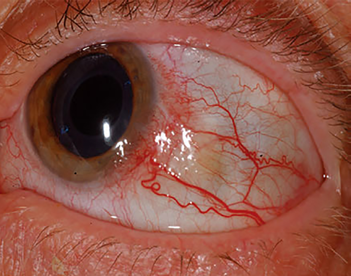 Conjunctival melanoma