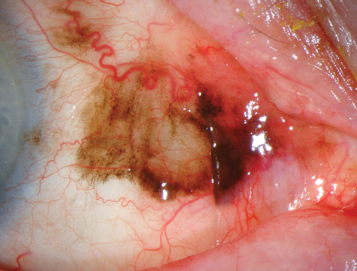 Conjunctival melanoma