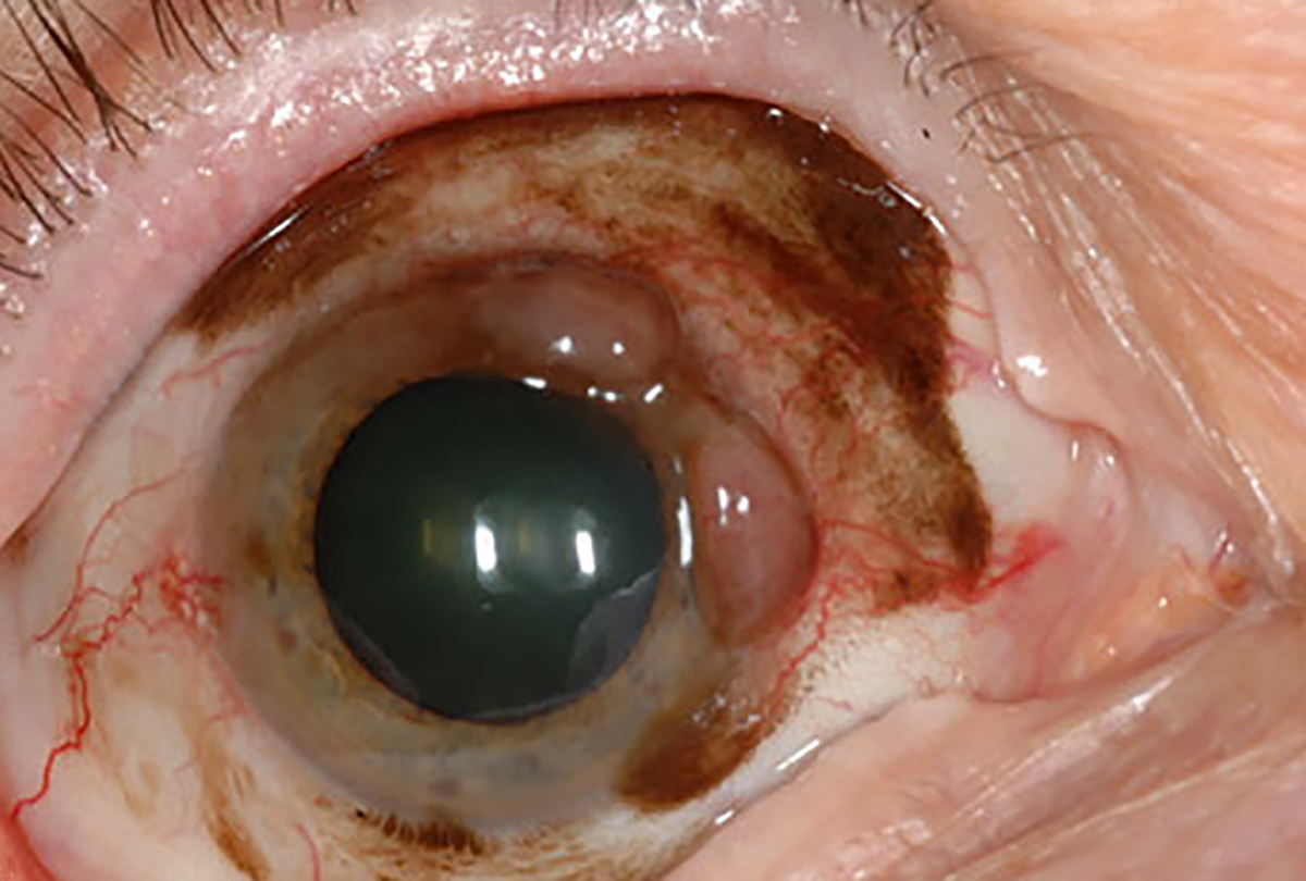 Conjunctival melanoma