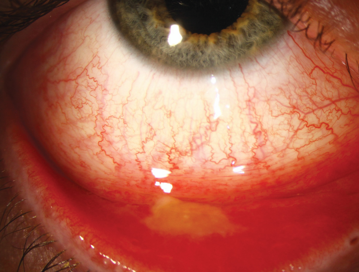 Epidemic keratoconjunctivitis