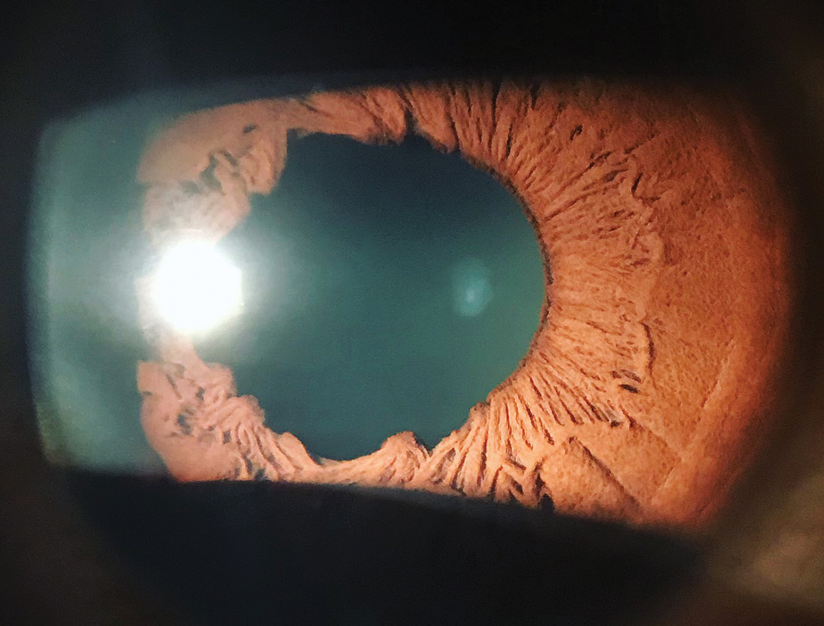 Iris sphincter tear