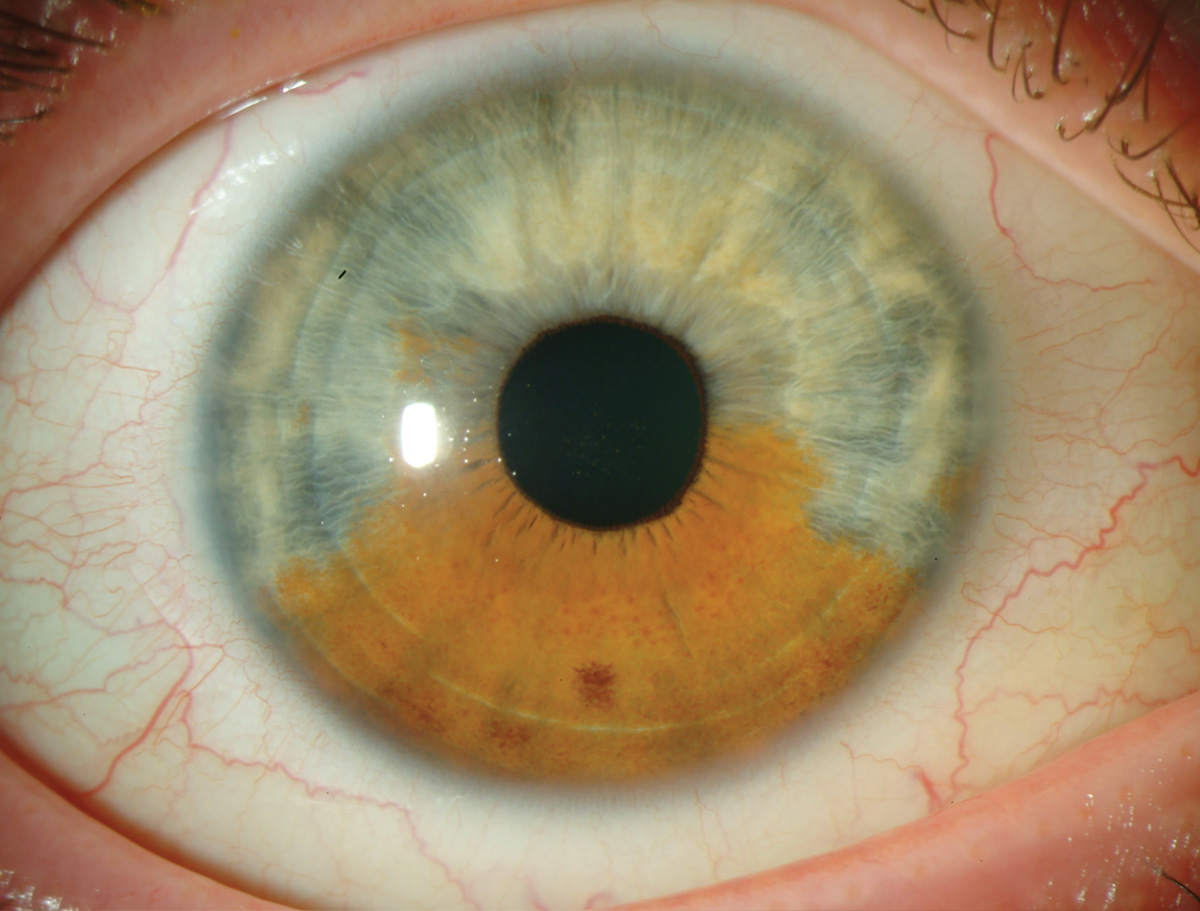 Iris melanocytosis