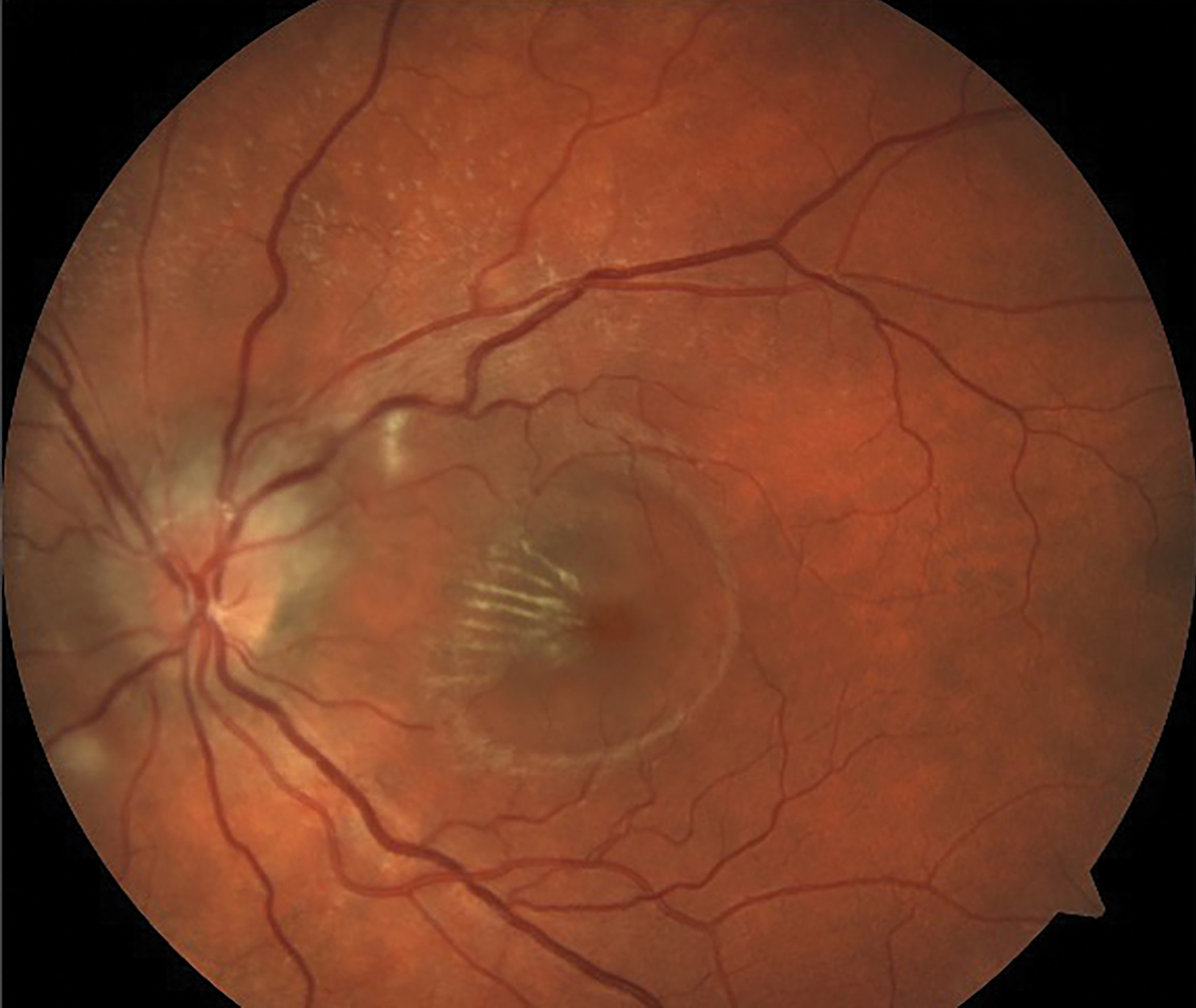 Neuroretinitis