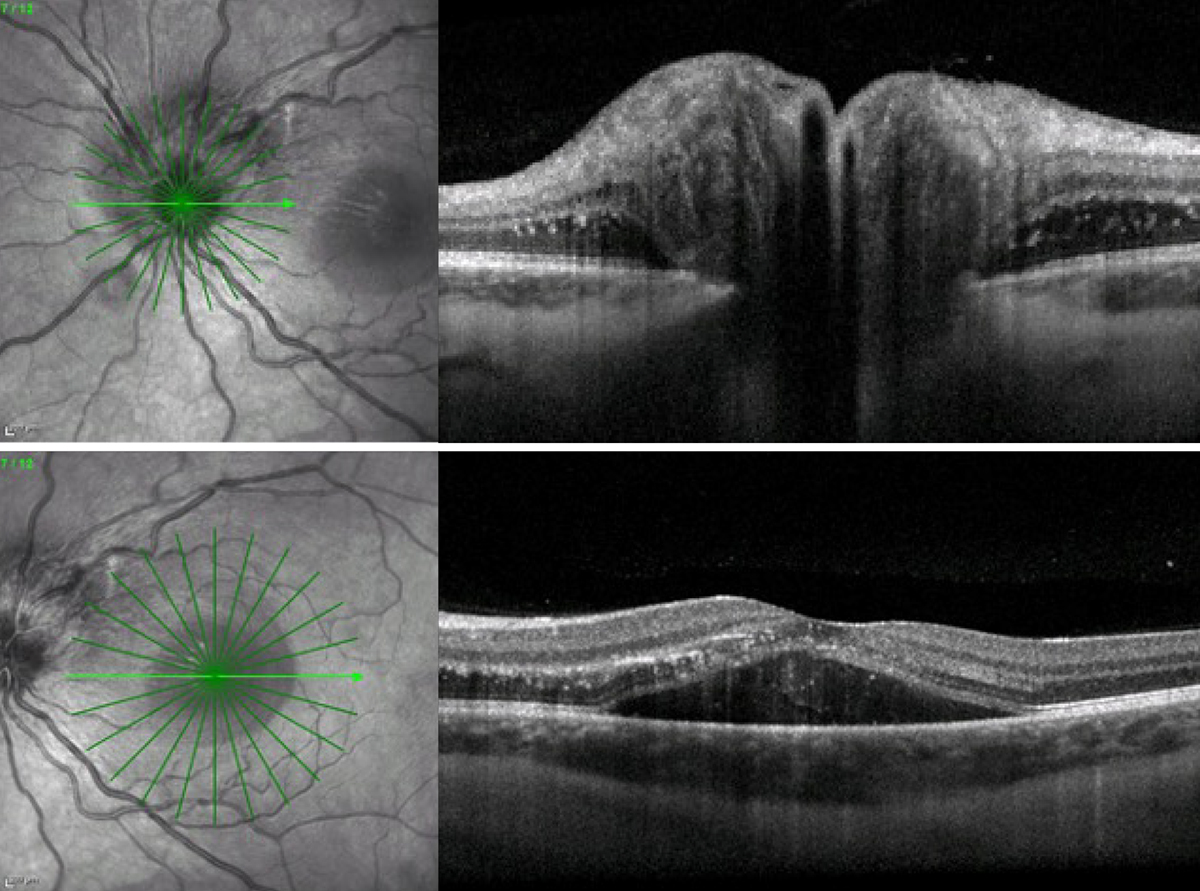 Neuroretinitis