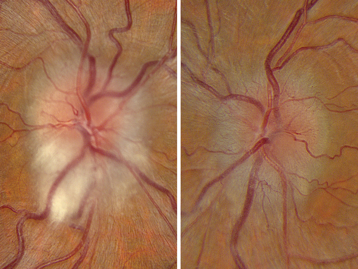 Idiopathic intracranial hypertension