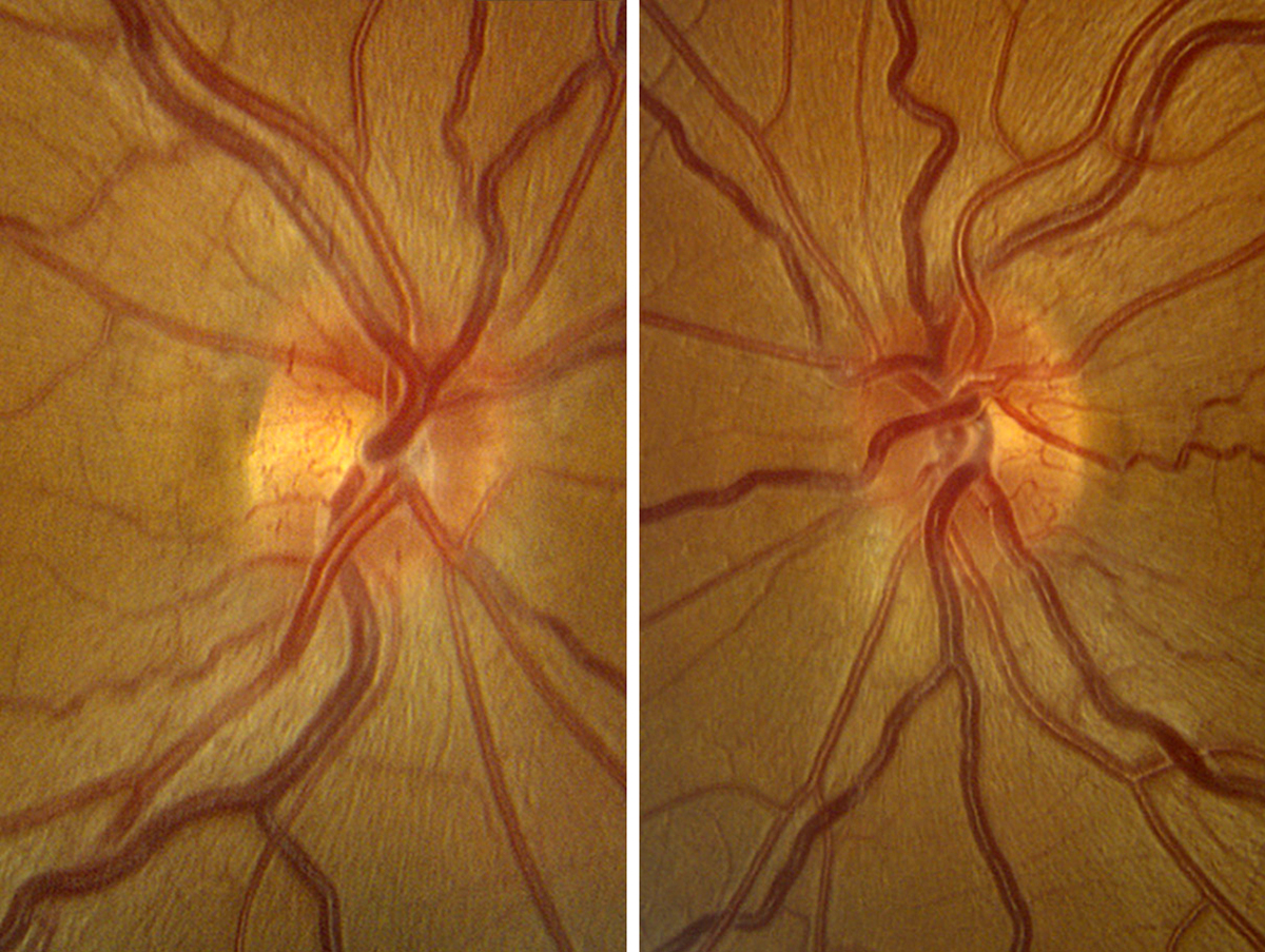 Leber’s hereditary optic neuropathy